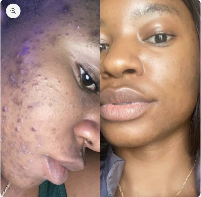FYRE SKIN client before and after acne results