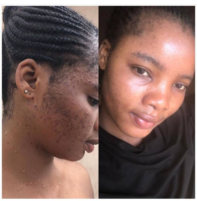 FYRE SKIN client before and after acne results