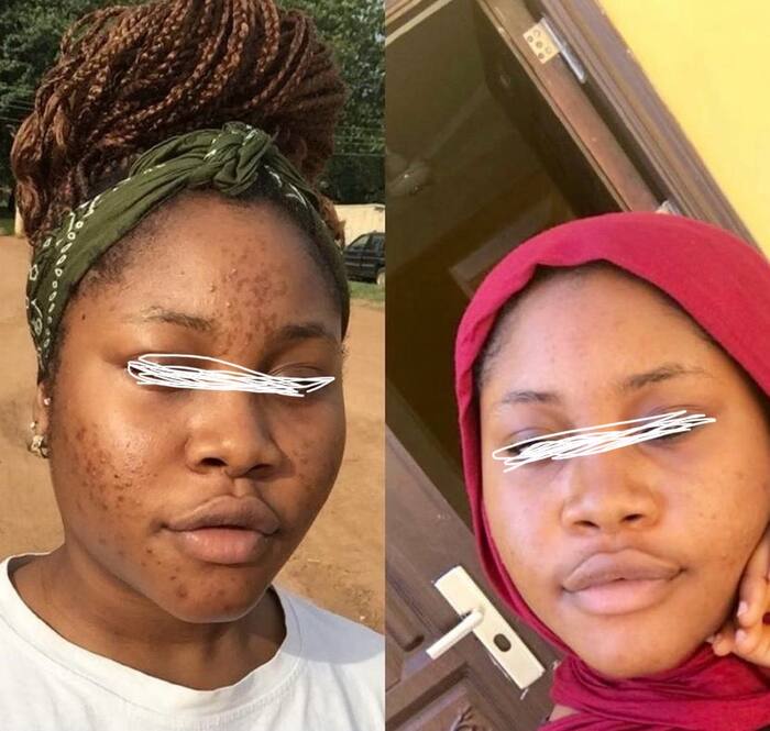 FYRE SKIN client before and after acne results
