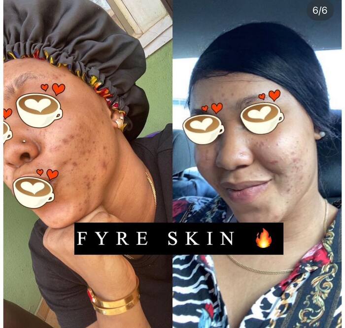 FYRE SKIN client before and after acne results